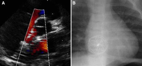 Postprocedural Tte And X Ray After Successful Asd Closure A Modified