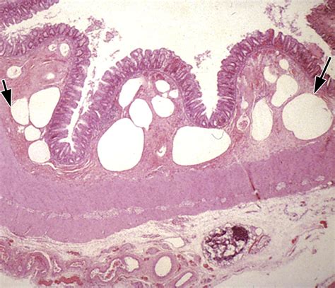 Necrotizing Enterocolitis Review Of State Of The Art Imaging Findings