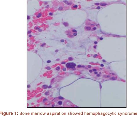 Figure From Unusual Case Of Adult Hemophagocytic Syndrome Semantic