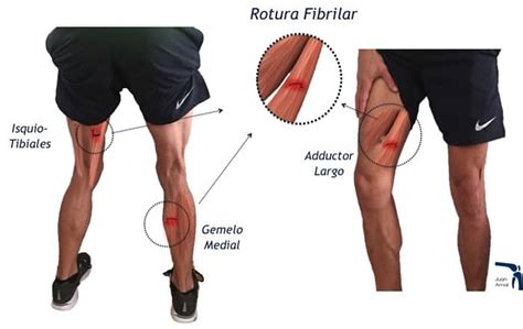 Rotura Fibrilar Juan Arnal Traumatologo En Madrid