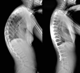 Scoliosis and Kyphosis Case Examples - Children's Orthopaedic and Scoliosis Surgery Associates, LLP