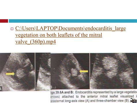 Echocardiographic Evaluation Of Mitral Valve Disease Mitral