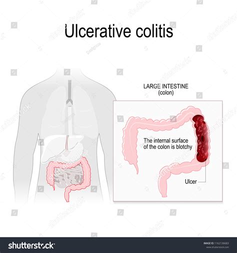 Ulcerative Colitis Inflammation Ulcers Colon Rectum Stock Vector Royalty Free 1162136683