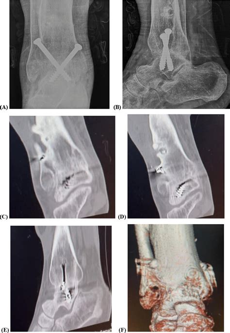 Plain Radiographs Show Radiographic Union At 5 Months Postoperatively