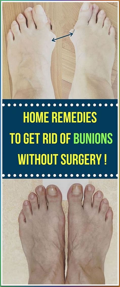 Here Is How To Get Rid Of Bunions Completely Natural Get Rid Of