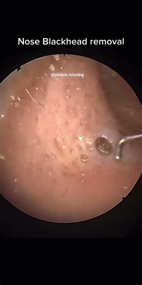 Warning The Dark Side Of Blackhead Popping Videos