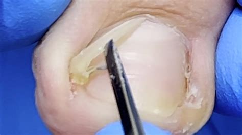 Digging Out Deep Ingrown Most Common Ingrown ShapesXue Yidao