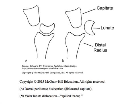 Lunate Dislocation – Core EM