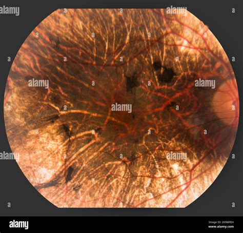 Trastorno De La Retina Fotografías E Imágenes De Alta Resolución Alamy