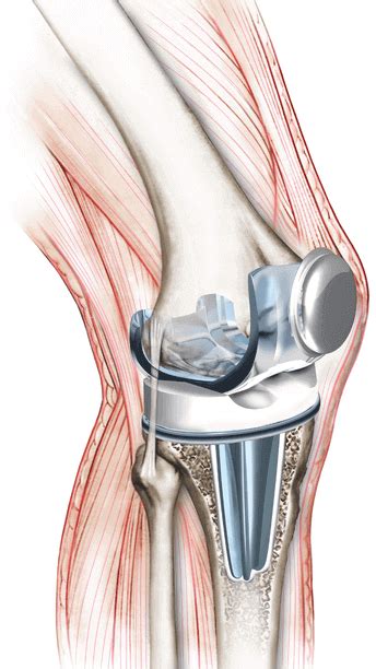 Qu Es Una Pr Tesis De Rodilla Vitalys Center Fisioterapia