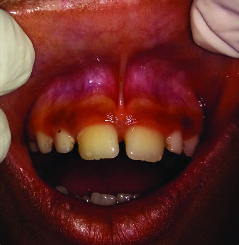 Preoperative view showing aberrant labial frenulum with midline ...