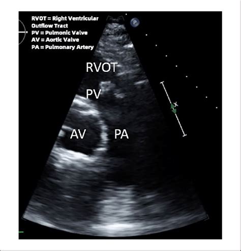 Transthoracic echocardiography showing vegetation attached to the ...