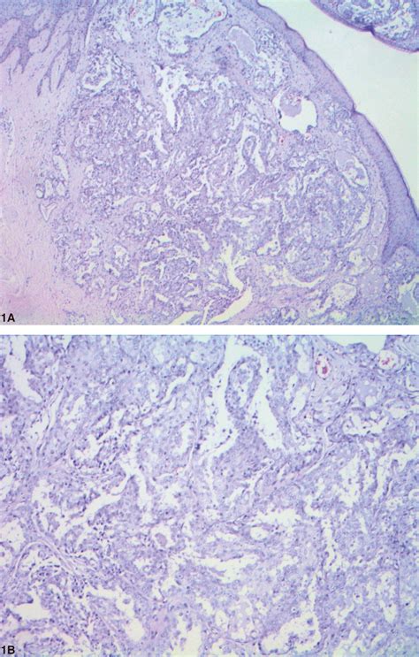 Ectopic Hidradenoma Papilliferum Anais Brasileiros De Dermatologia