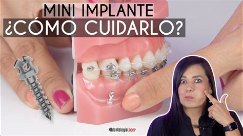 C Mo Limpiar Los Mini Implantes De Ortodoncia Qu Debo Usar