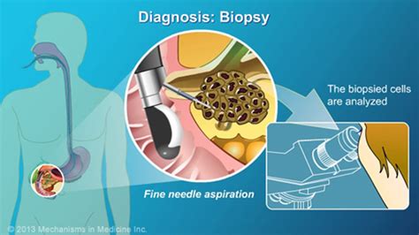 Pancreatic Cancer Pathophysiology Diagnosis And Staging