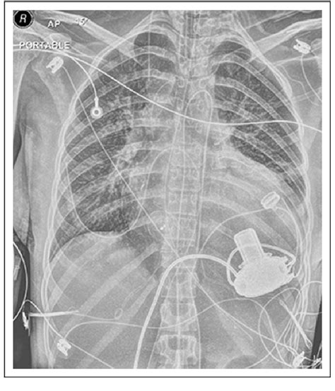 Figure 2 From Use Of HeartWare Ventricular Assist System For Systemic