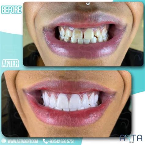 Best Turkish Veneers Veneers In Turkey At Best Price