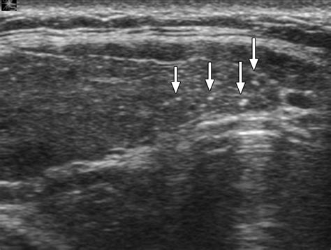 Papillary Thyroid Carcinoma Manifested Solely As Microcalcifications On