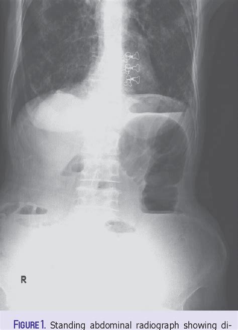 Figure 1 From A Rare Cause Of Acute Mechanical Intestinal Obstruction