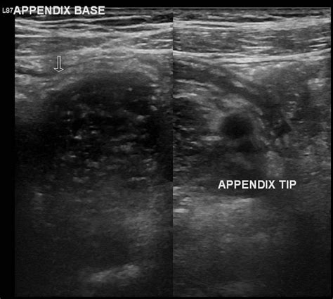 Appendicitis Ultrasound Radiopaedia Appendicitis is inflammation of the ...