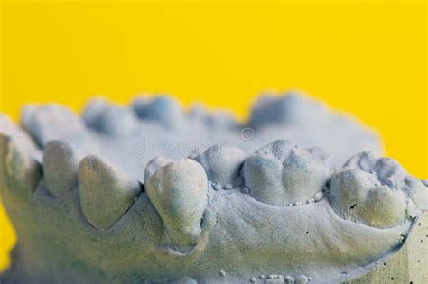 Blue Plaster Model Of An Impression Of A Patient S Jaw At An