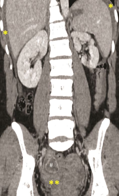 Computed Tomography An Optimal Modality For The Detection Of