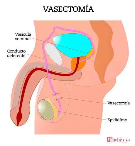 Vasectom A Sencilla Operaci N Para No Tener Hijos