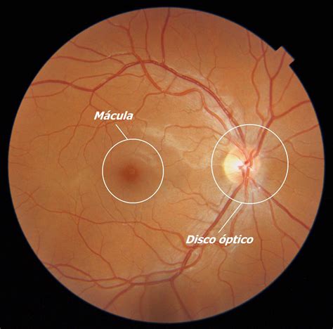 La Degeneraci N Macular Asociada A La Edad Dmae Ptica Bogas