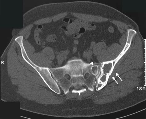 Axial Ct In Bone Density Demonstrates A Lytic Expansible Lesion With