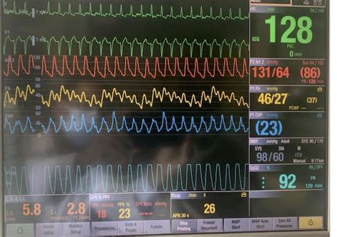 Ahmed T Abdellah On Twitter Pocus Pt S P Cabg With Ef