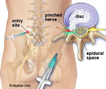 Epidural steroid injection esi spine injections steroid shots in spine ...