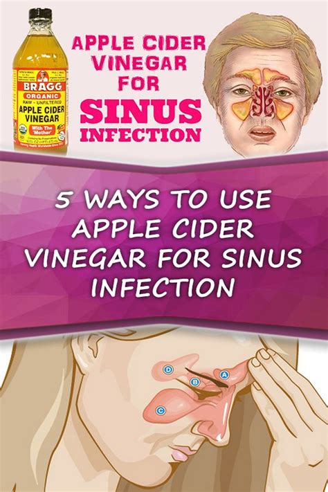 5 Ways To Use Apple Cider Vinegar For Sinus Infection Sinusitis Sinus Infection Apple Cider