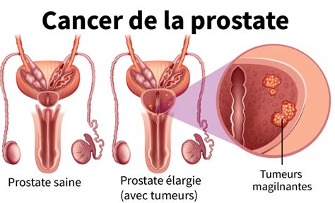 Traitement Du Cancer De La Prostate Efficacité De La Radiothérapie Information Hospitalière