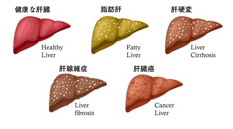 脂肪肝の人は約1000万人以上存在する？知ってるようでよく知らない「脂肪肝」について医師が解説 ヨガジャーナルオンライン