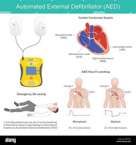 Desfibrilador Externo Autom Tico Es Un Dispositivo Electr Nico Para El