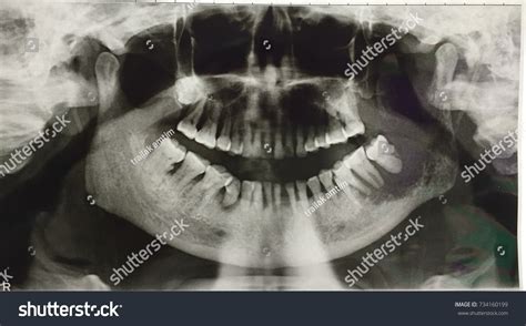 47 Tmj X Ray Images, Stock Photos & Vectors | Shutterstock