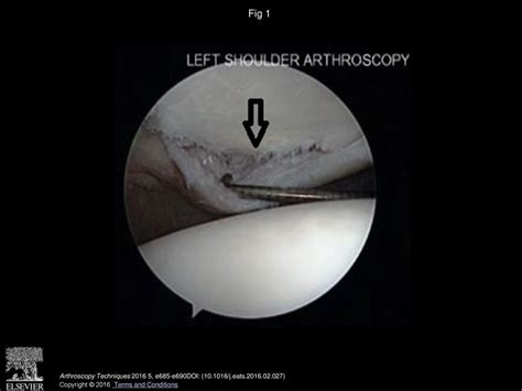 Arthroscopic Repair Of Inferior Labrum Anterior To Posterior Lesions Of