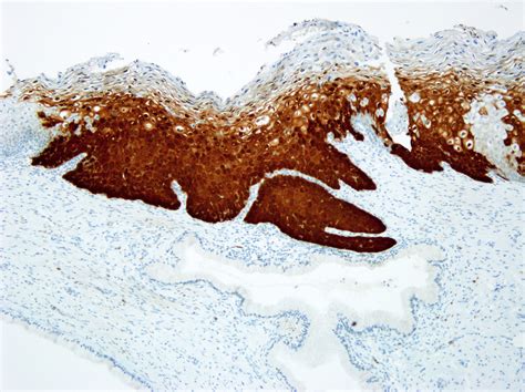 World Health Organization recommends use of p16 IHC to help diagnose