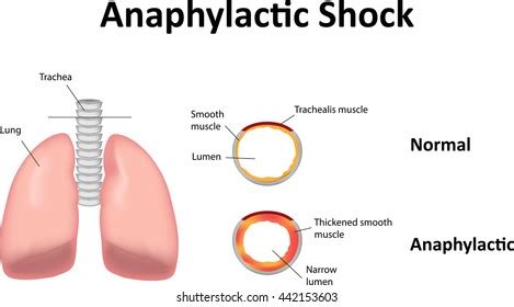 573 Shock anaphylactic Images, Stock Photos & Vectors | Shutterstock