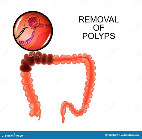 Polyps in the Colon. Removal of Polyps Stock Vector - Illustration of ...