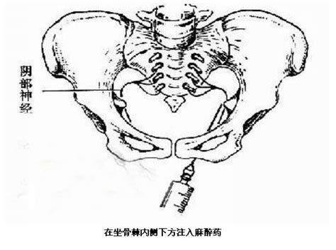 顺产会阴处侧切手术 手术图解 医学图库