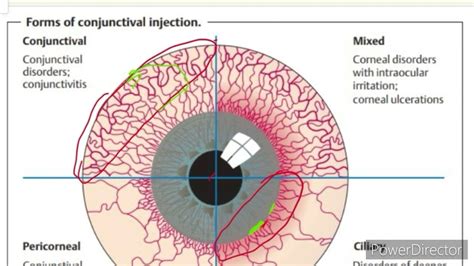 Conjunctival Injection