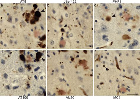 Tau Grains And Plaque Associated Dystrophic Neurites In Xfad Mice