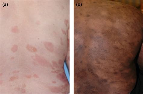 Mycosis Fungoides Symptoms And Treatment Off