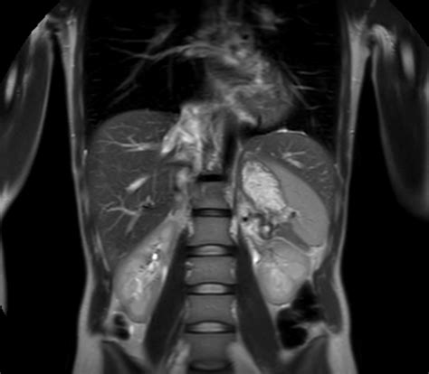 Liver And Pancreas Philips Mr Body Map