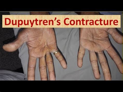 Dupuytren S Contracture In Chronic Liver Disease YouTube