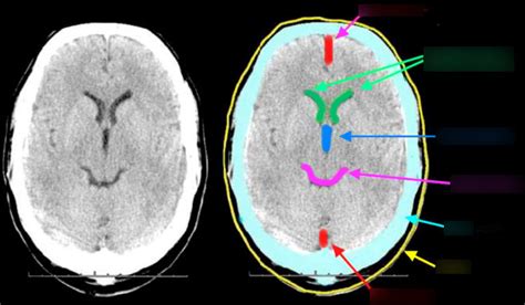 CNS Imaging Diagram | Quizlet