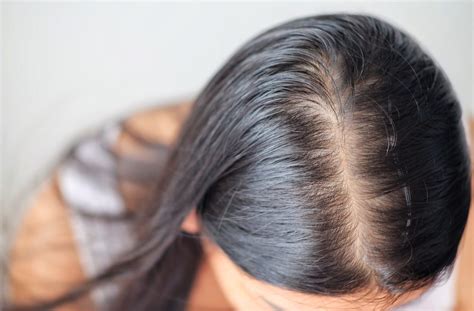 Saçkıran nedir Alopesi areata ne demek