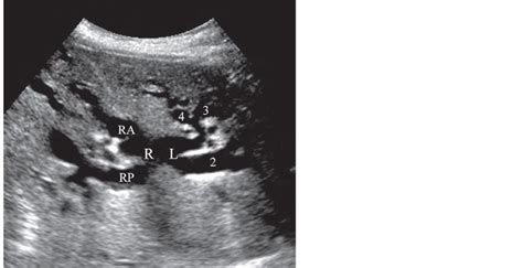 Common Hepatic Duct Ultrasound