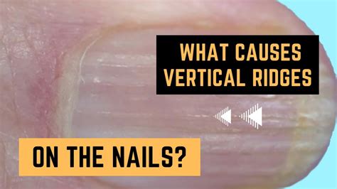 What Causes Vertical Ridges On The Nails Youtube